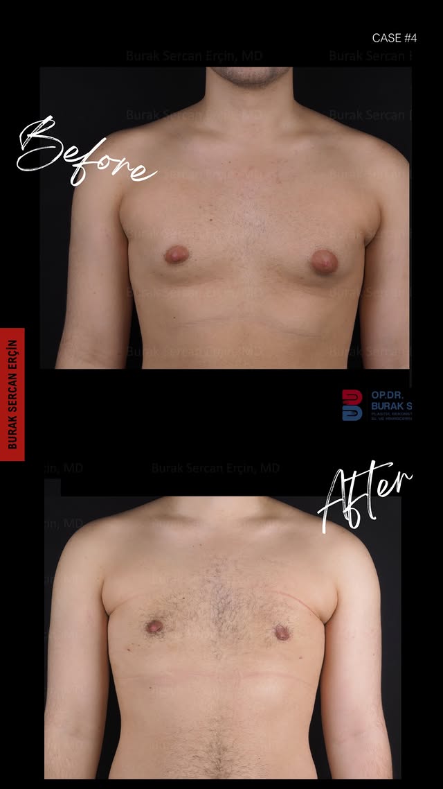 Gynecomastia surgery before and after, case 3