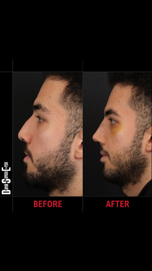 Male nose tip before and after refinement in thicker skin