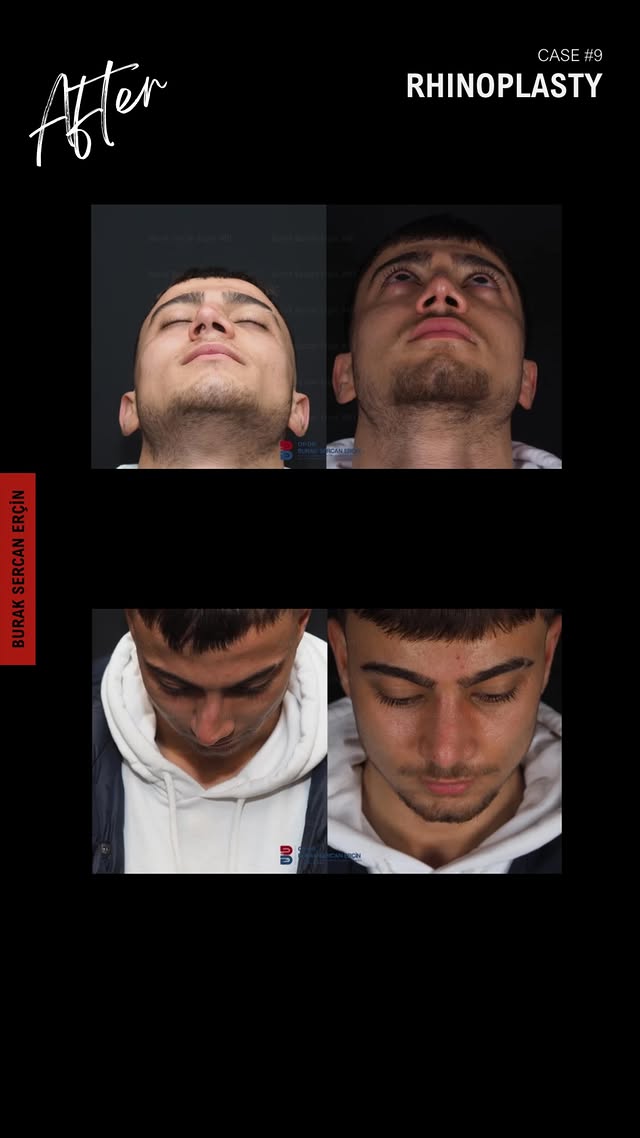 Male rhinoplasty before and after, case 5