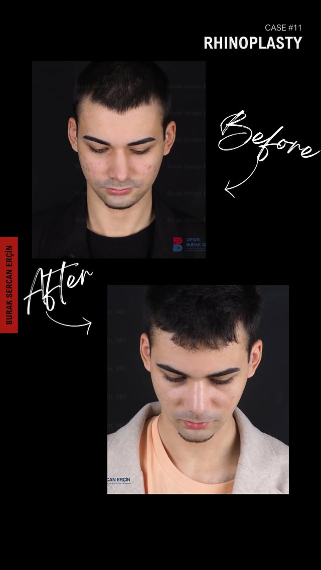 Crooked male nose before and after straightening of the bone and septum