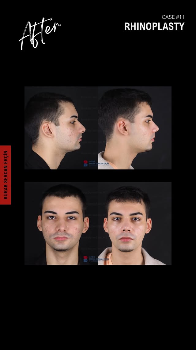 Male rhinoplasty before and after, case 3