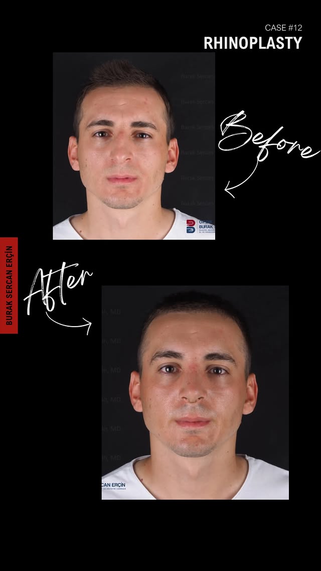 Male rhinoplasty before and after, case 1