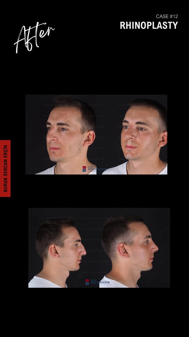Male rhinoplasty before and after, case 2
