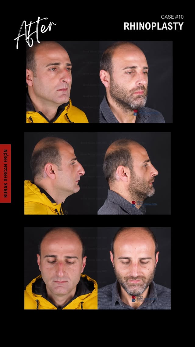 Male rhinoplasty before and after, case 6