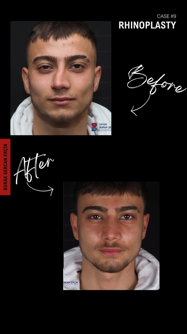 Male rhinoplasty before and after, case 4