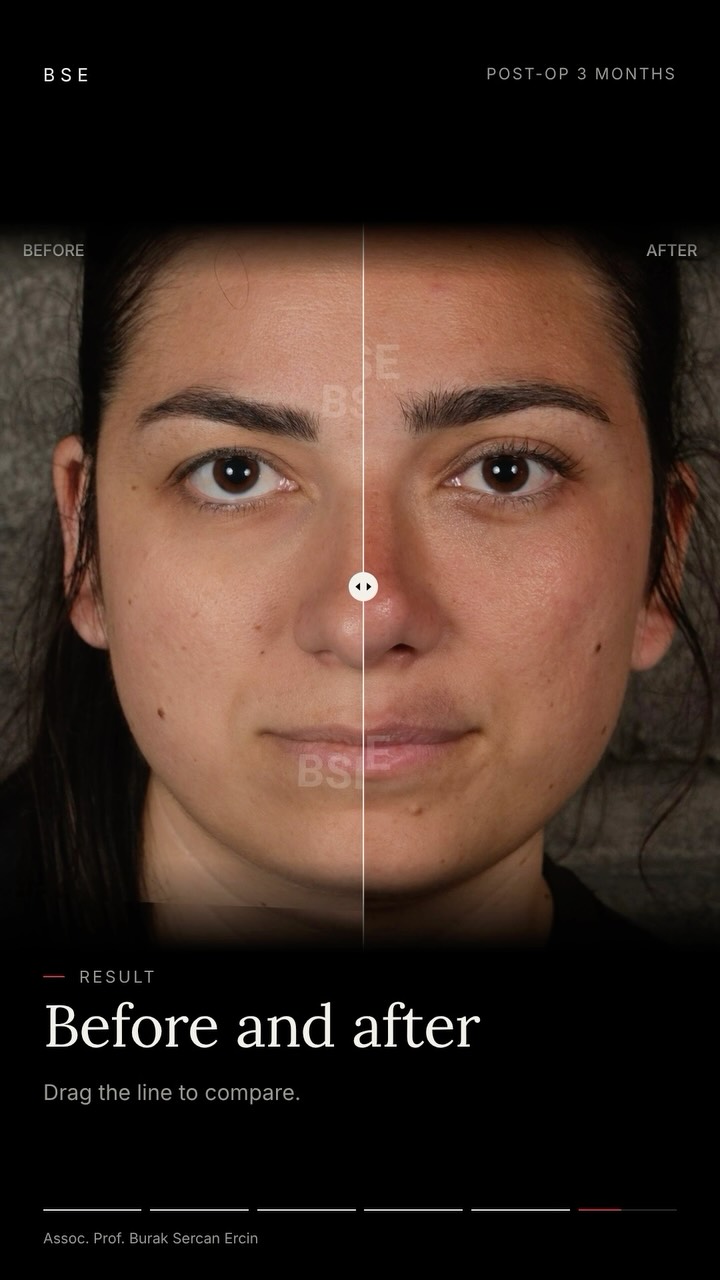 before after facelift aesthetic before after facelift aesthetic